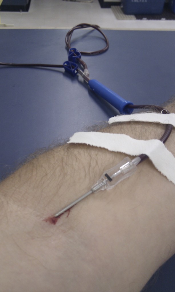 Eine Person Hand mit einem Kochsalzschlauch und einer Nadel sowie mehreren Pflastern auf der Haut.